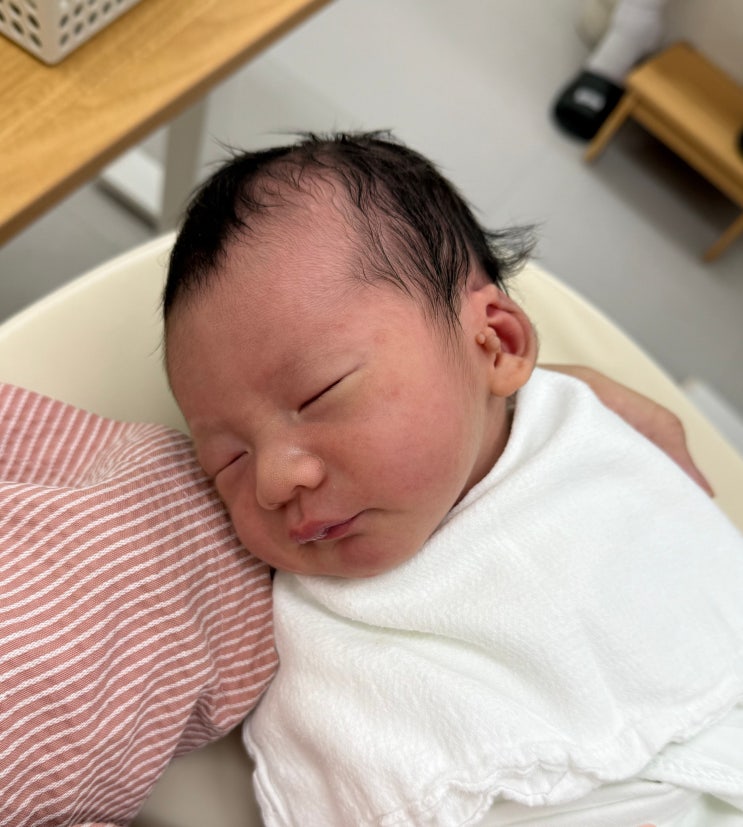  신생아 스킨텍 귀젖 제거 수술비용, 보험까지(강남 지디에스 성형외과)