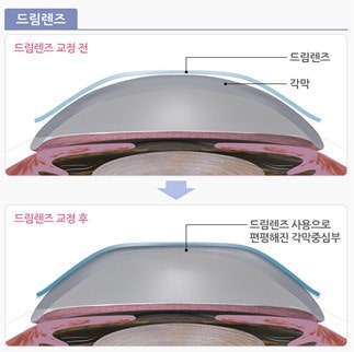 드림렌즈 성인도 할 수 있나요? 시력교정 원리, 착용기간, 가격, 난시, 고도근시, 노안, 부작....
