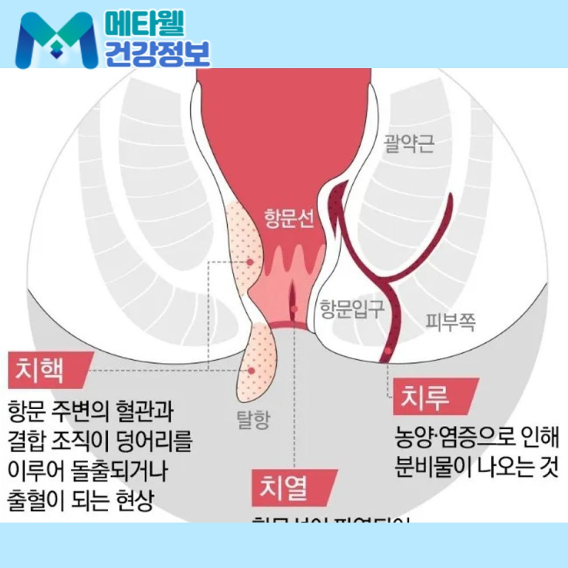 치루 초기증상과 원인, 치료 방법: 재발하는 이유까지 정리