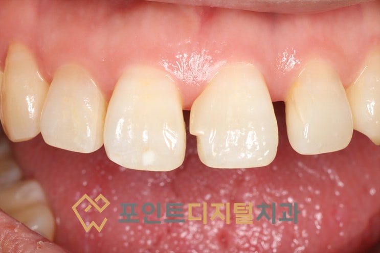 앞니 벌어짐 레진 치료 재치료, 바이오클리어로 자연스럽게 해결(레진빌드업) / 천안 아산 앞니 벌어짐 레진 치료 재치료, 바이오클리어로 자연스럽게 해결(레진빌드업) / 천안 아산