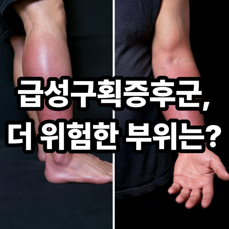  급성구획증후군 다리 vs 팔 차이, 어디가 더 위험할까? 증상 비교 총정리