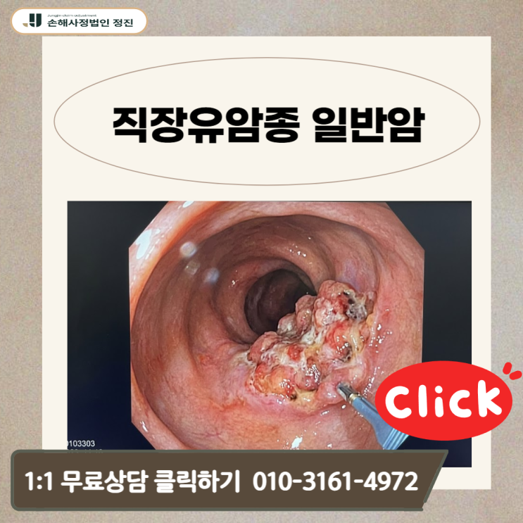  직장유암종 일반암, 20%만 받았다면 거의 잘못 지급입니다.(전액 받는 기준 공개)