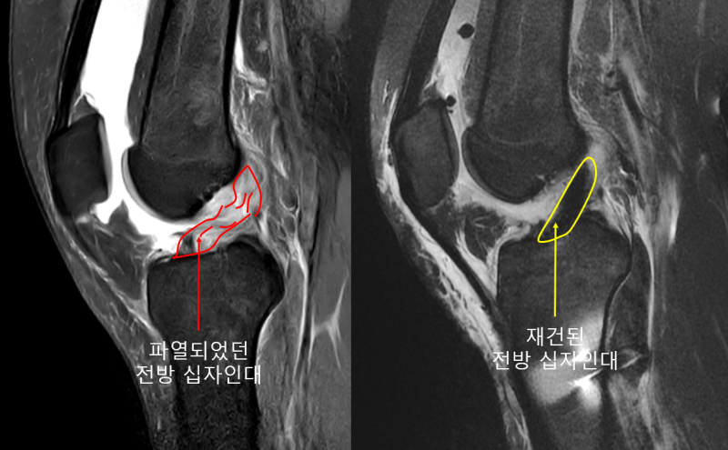 전방십자인대 파열, 관절경하 전방십자인대 재건술 – 봉합이 아닌 재건을 하는 이유?