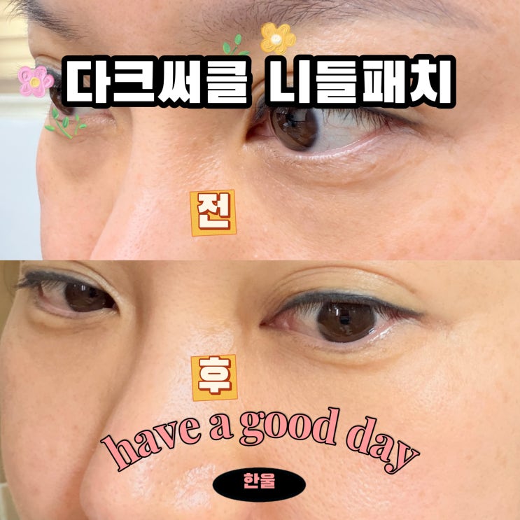  샤르드 아이백 리프트 패치 마이크로 눈밑 니들패치 추천