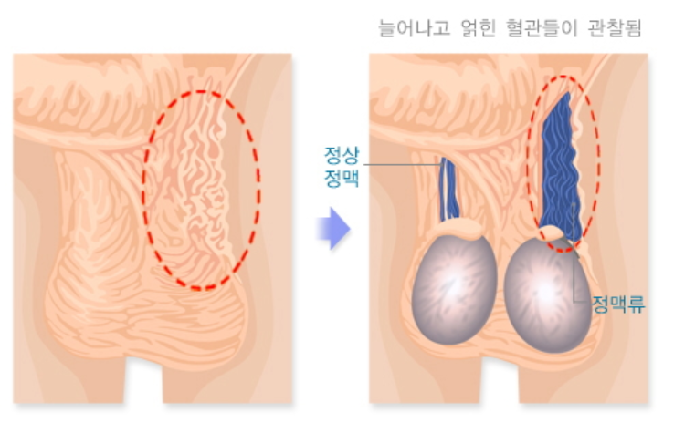정계정맥류 왜 고환에 문제를 일으킬까?