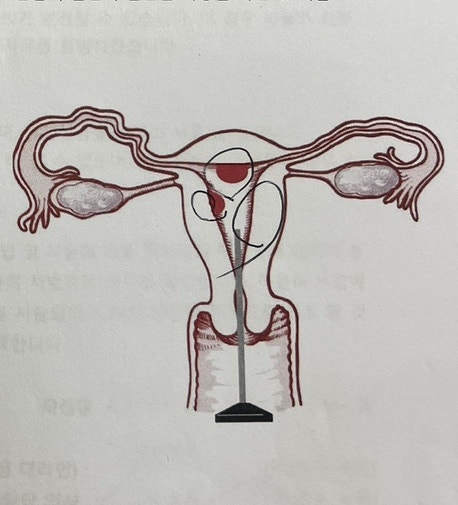 창원 아가나 자궁경으로 자궁 폴립(용종) 제거 후기/원인.. 많았다고 함