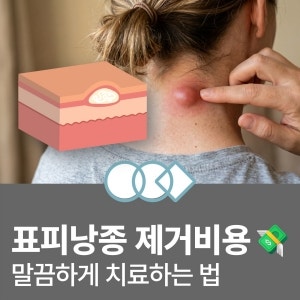 표피낭종 제거비용 및 말끔하게 치료하는 법