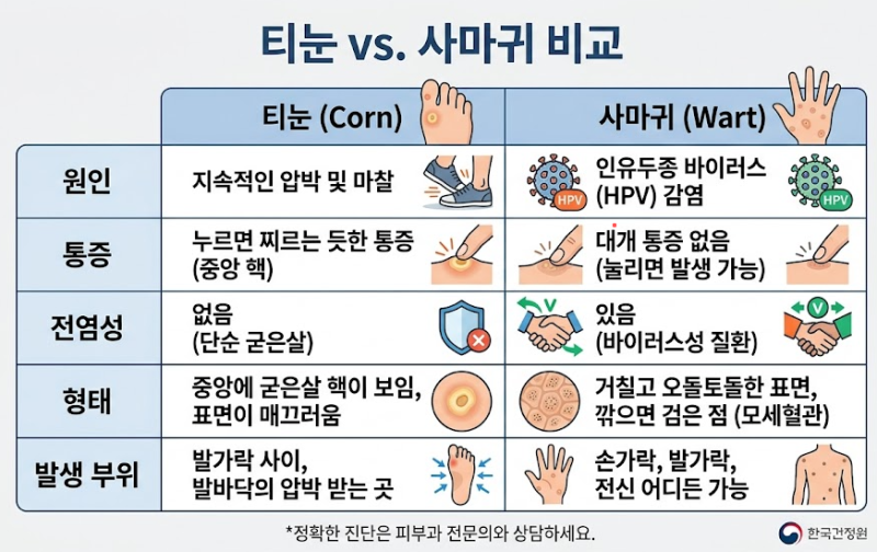 [레푸스 수원영통점] 굳은살? 티눈 혹시 사마귀?? 뭐가 다른가요?