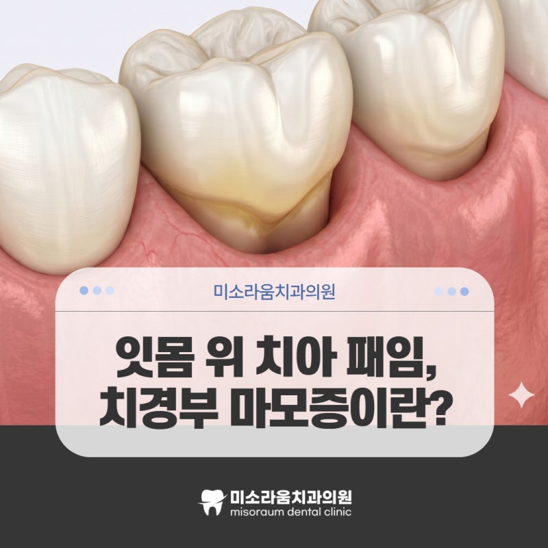 잇몸 부위 치아 패임 원인과 시린 이, 원데이 레진 치료