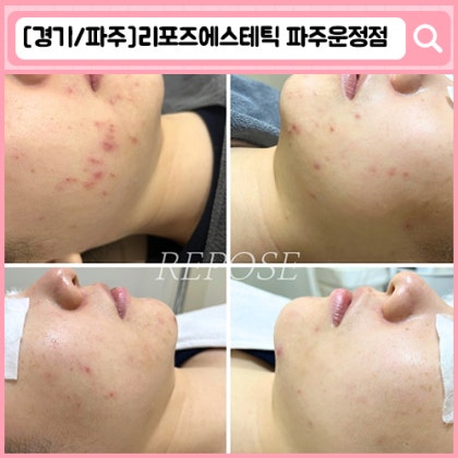 '리포즈에스테틱' 운정 피부관리