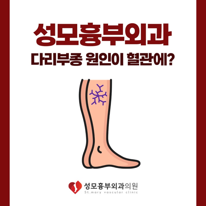청주하지정맥류 다리 저림과 쥐가 반복된다면