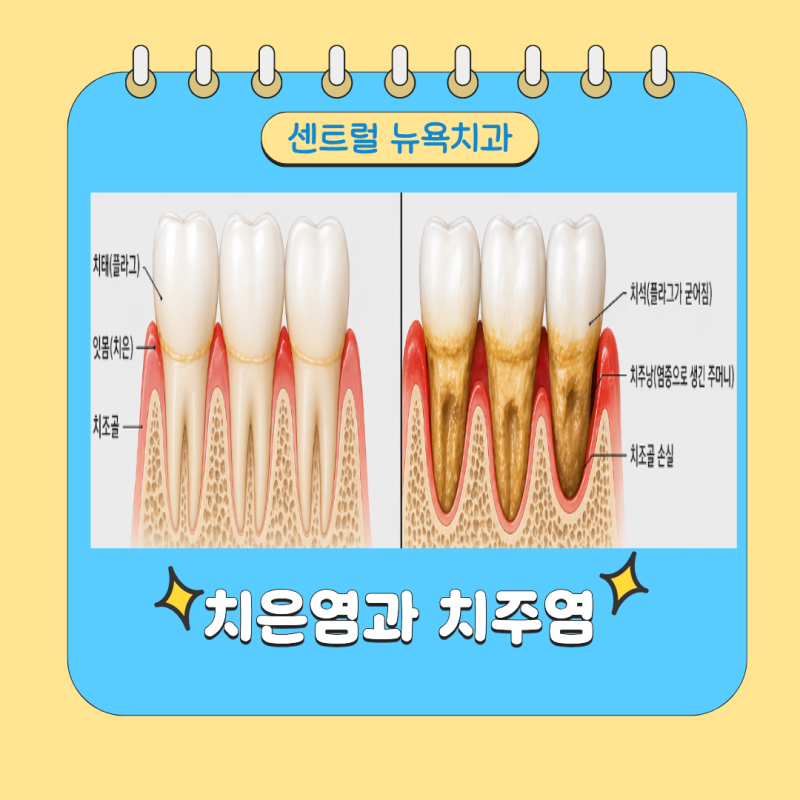 강동구 천호동 치과에서 알려드리는 치은염과 치주염