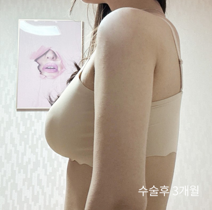  팔뚝살처짐, 운동으로 안 빠지는 이유는? 결국 팔거상술이 필요한 3가지 유형