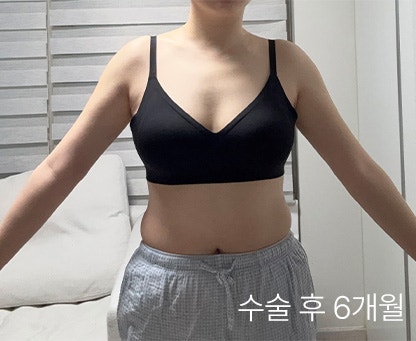  팔뚝살지흡 재수술 없이 한 번에 끝내는 일자라인 공식