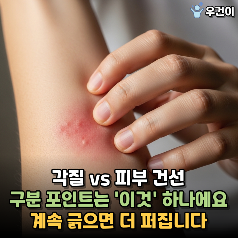 각질 vs 건선 증상..구분 포인트 '이것' 이었네요. 그것도 모르고 제거하고 있었어요