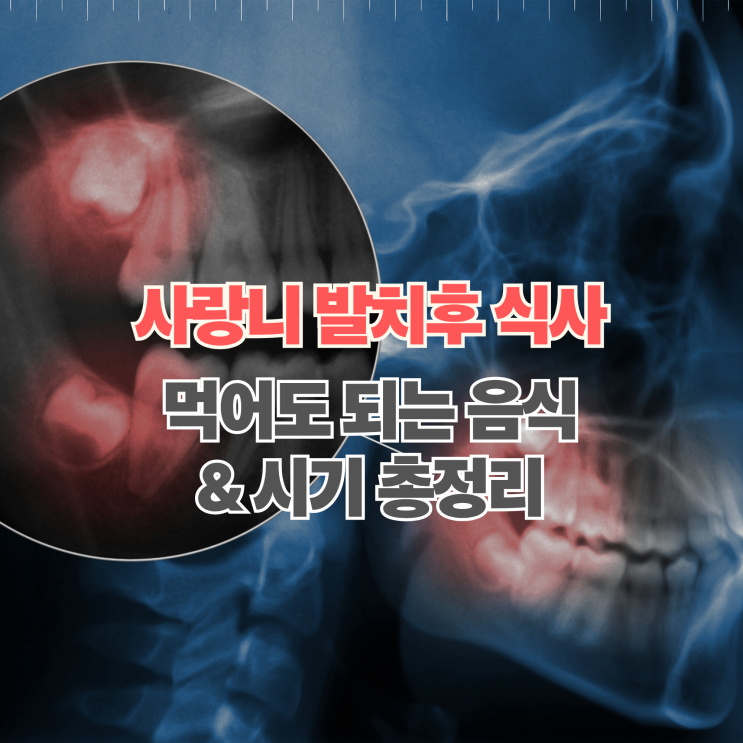  사랑니 발치후 식사 언제부터? 먹어도 되는 음식 및 주의사항 총정리