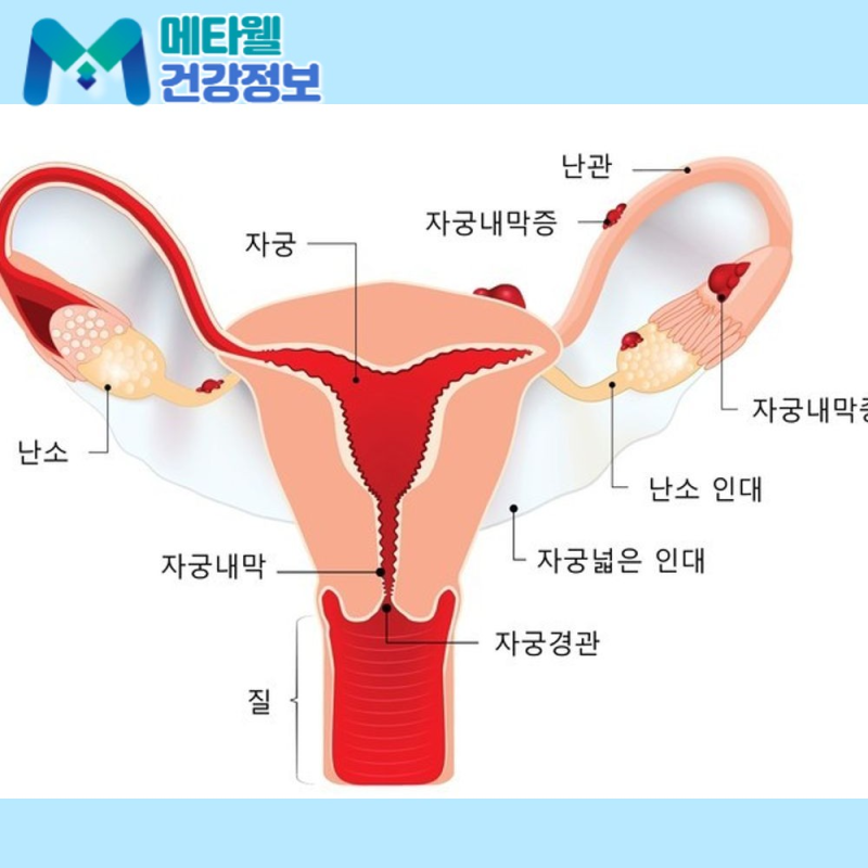 생리통이 점점 심해진다면? 자궁내막증 증상과 원인, 임신 가능성까지