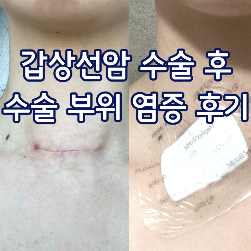 갑상선암 수술 후 병원에 또 간 이유, 수술 부위 염증 두 번 겪은 후기