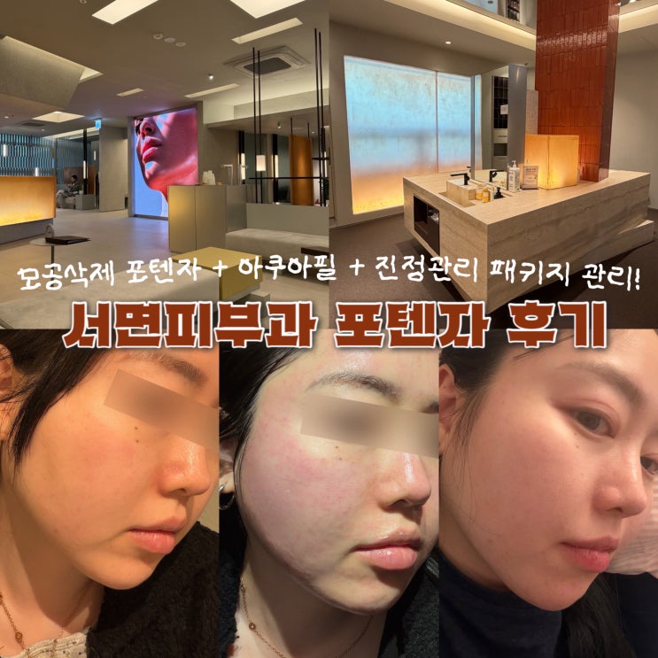  서면피부과 모공 축소 포텐자 패키지 효과 통증 7일 후기