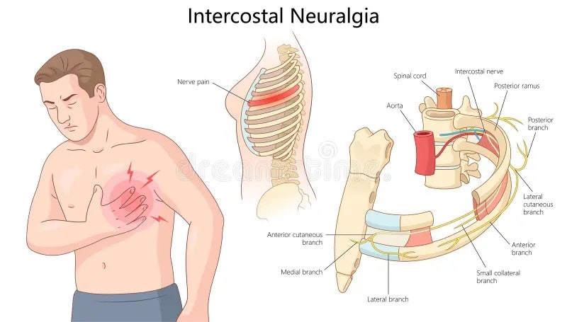 늑간신경통(Intercostal Neuralgia)