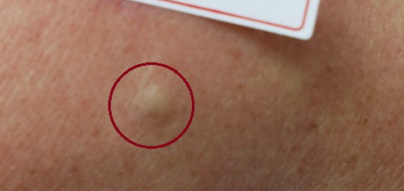 피지낭종 수술 후 재발? 완전히 제거해도 다시 생기는 이유 (치료방법별 재발율 논문확인)