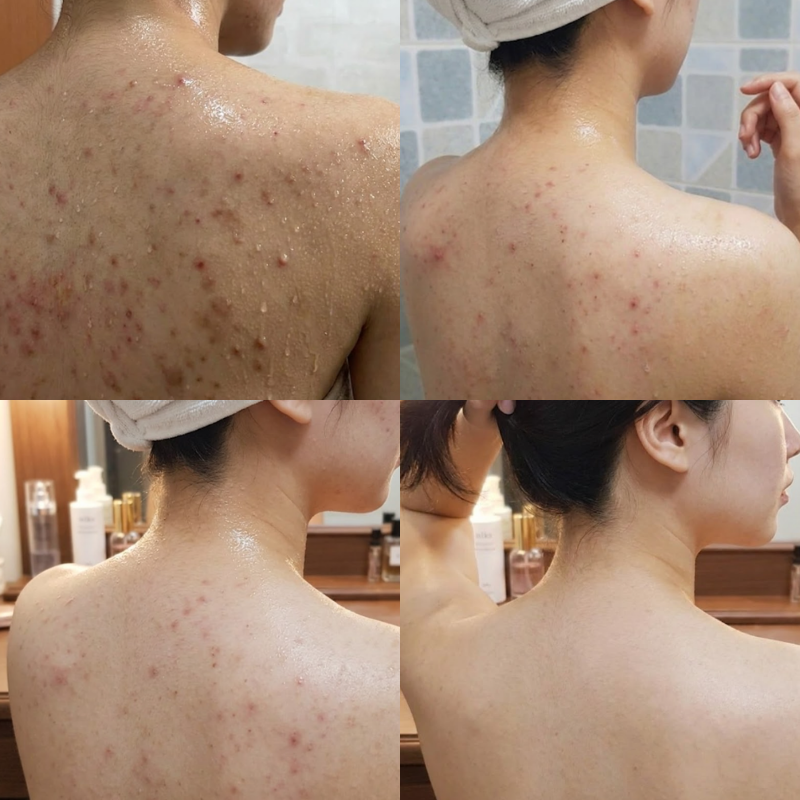 니조랄 등드름 효과 부작용 약초필링 에센스 비교 후기