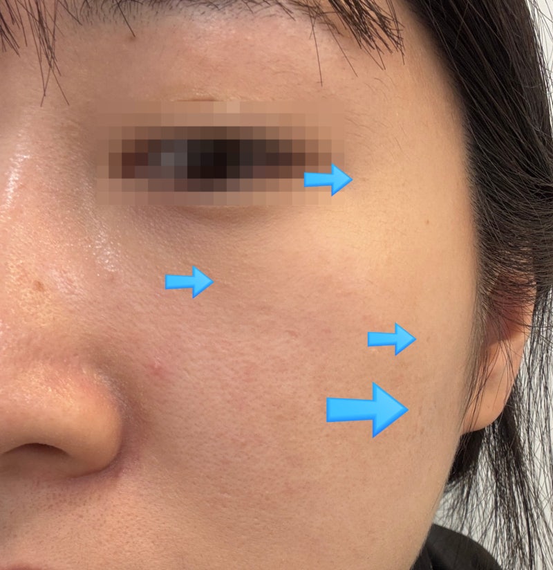 대구편평사마귀성지ㅣ대구편평사마귀무제한 + 대구쥐젖제거까지 해본 7일차 후기