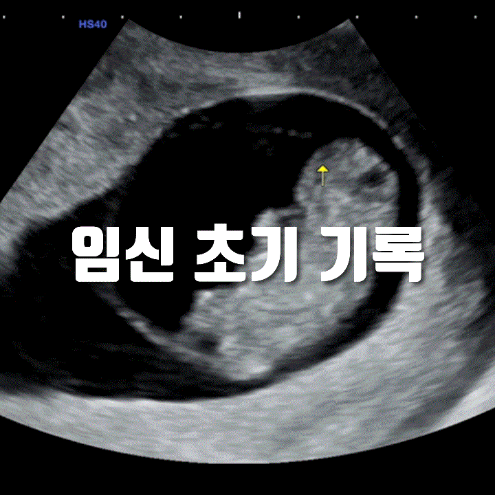  나의 임신 초기 리얼 후기: 입덧, 졸림, 그리고 조금씩 괜찮아지는 과정(5주-14주 까지)