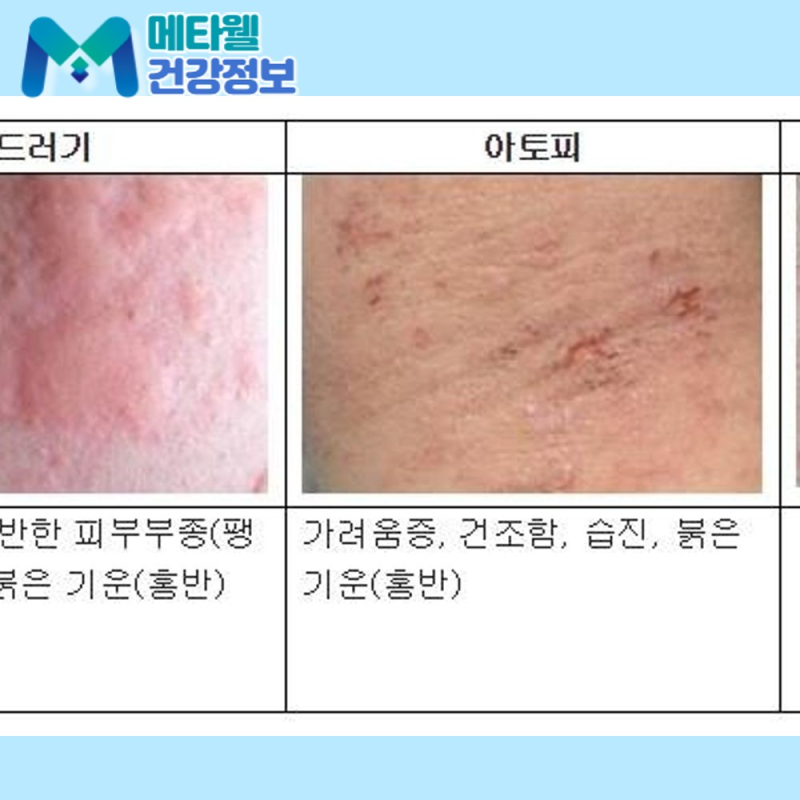갑자기 온몸이 부풀어 오른다면? 급성 두드러기 원인과 한랭 두드러기까지