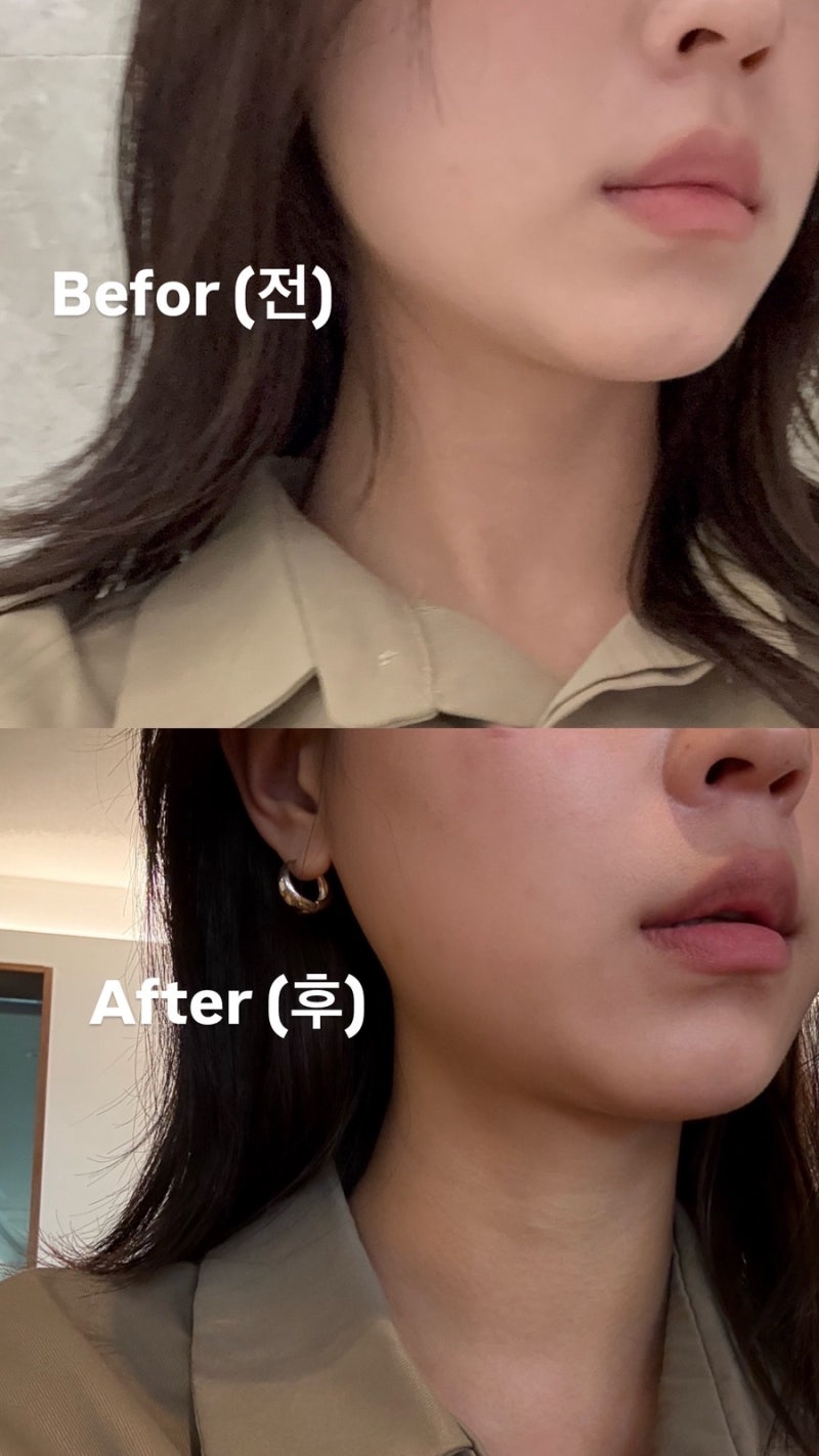 [서울/강남 피부과] 턱보톡스 + 귀밑샘보톡스 후기 (가격, 효과)