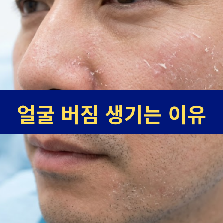  얼굴 버짐 원인 | 백색비강진 | 얼굴 버즘 생기는 이유와 없애는 법