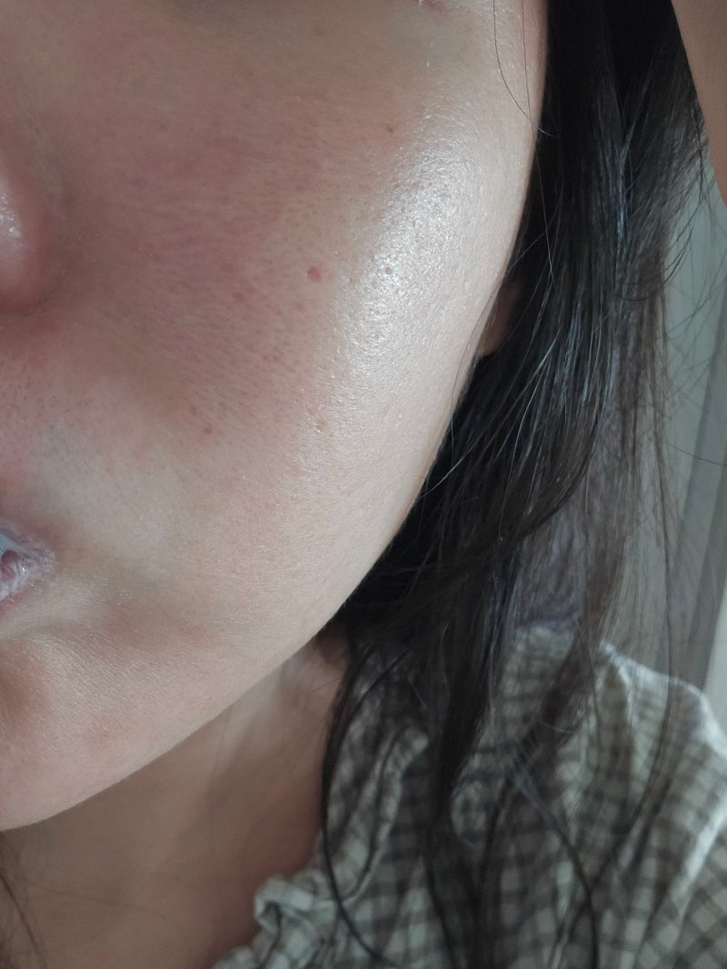 대기 어마어마한 대구 피부과 예수의원 주사피부염 진료 후기