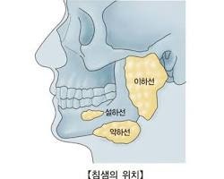 타석증과 타액선염 증상 및 대처법