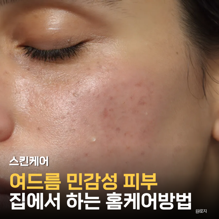  여드름 민감 피부 세안 데일리 스킨케어 홈케어 루틴
