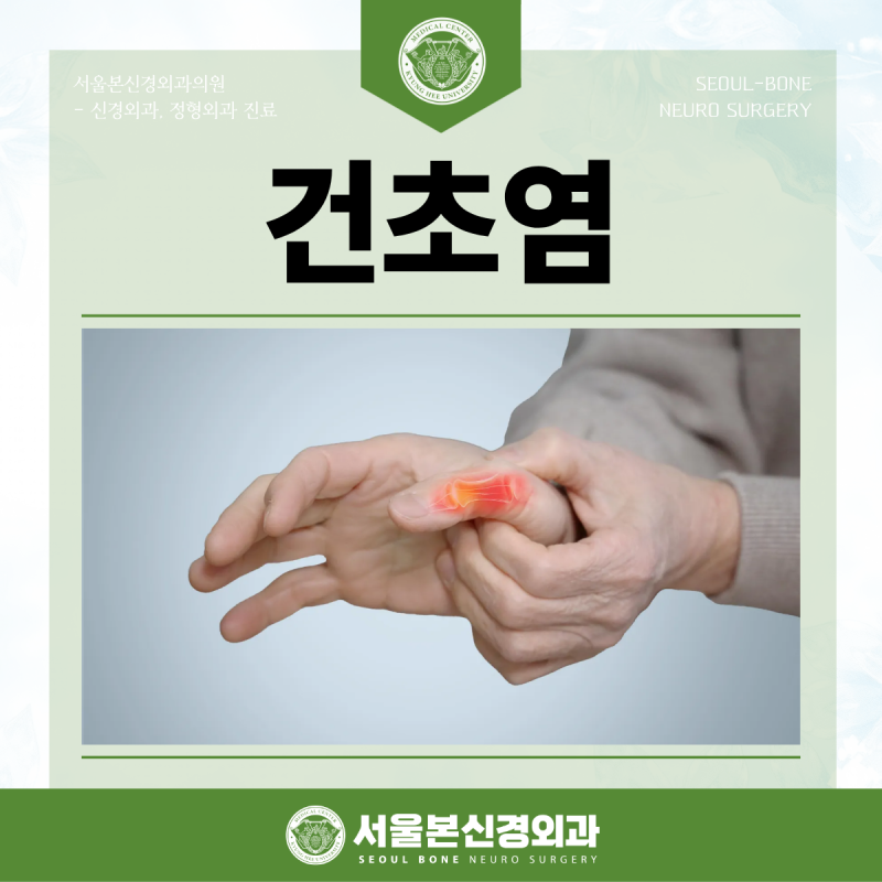 대구 손가락통증 병원, 엄지나 손목까지 아픈 증상이 나타나는 건초염 치료는