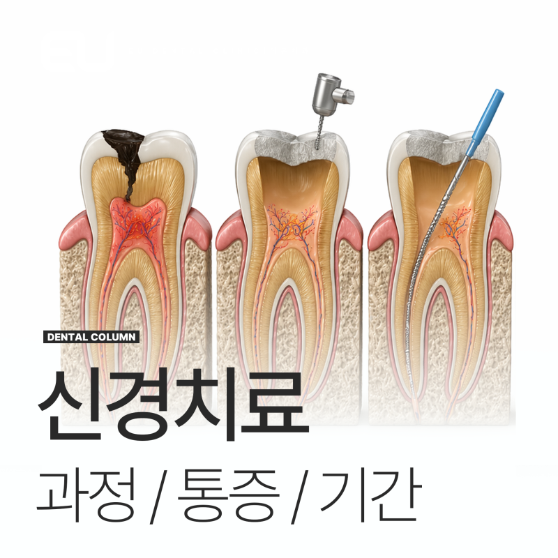 어금니 이빨 1차 신경치료 후 통증 기간?