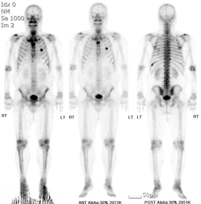 이문동 부부 한의원에서 알려드립니다. Bone Scan(골스캔) 검사, 무엇을 보는 검사일까요?