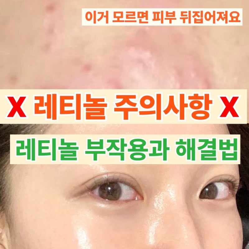 레티놀 주의사항 총정리직접 써보고 정리한 부작용과 해결법