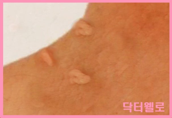 쥐젖 제거 크림으로 셀프 제거? 논문으로 살펴보는 쥐젖 원인과 비용 총정리(겨드랑이, 목, ....