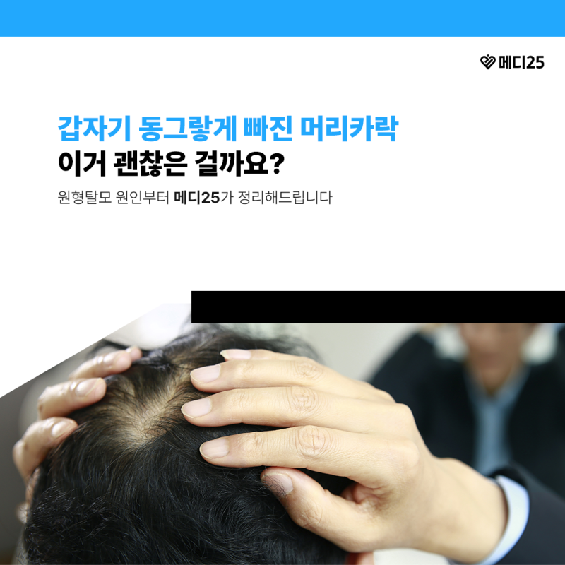 여성 출산 후 원형탈모증 원인, 왜 동그랗게 빠질까