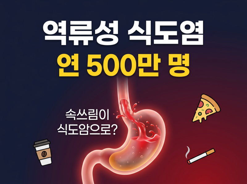 속쓰림이 3개월 넘으면?" 연 500만 명 역류성 식도염, 식도암 되기 전 자가진단법