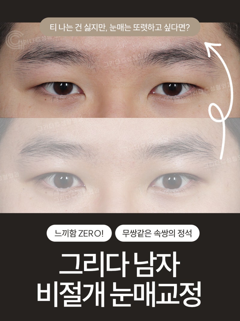 남자 비절개 눈매교정 느끼함 없이 담백하고 또렷하게