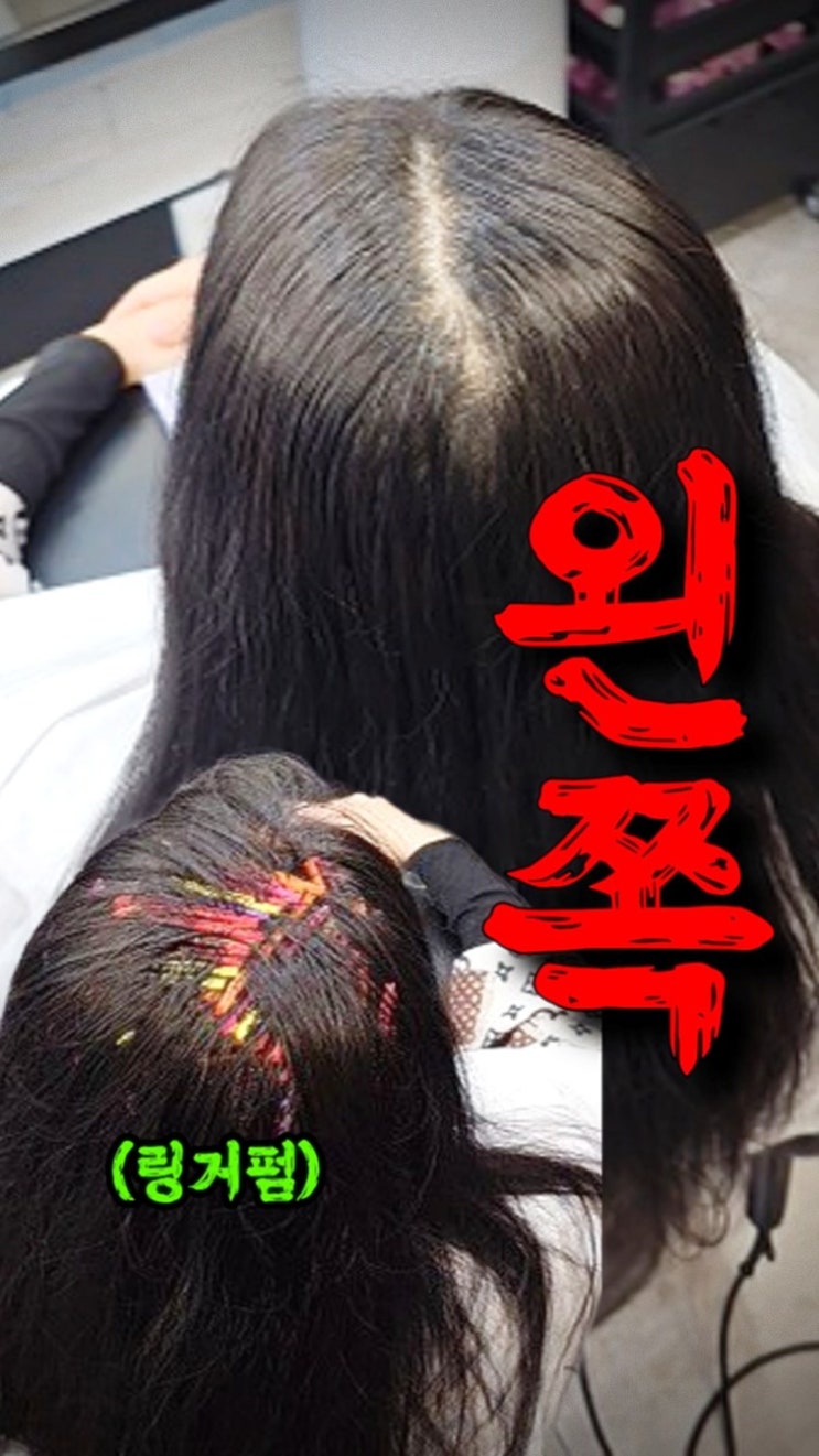  삼성동 링거펌 찾다가 수원까지? 뒤통수 갈라짐 완벽 해결 후기