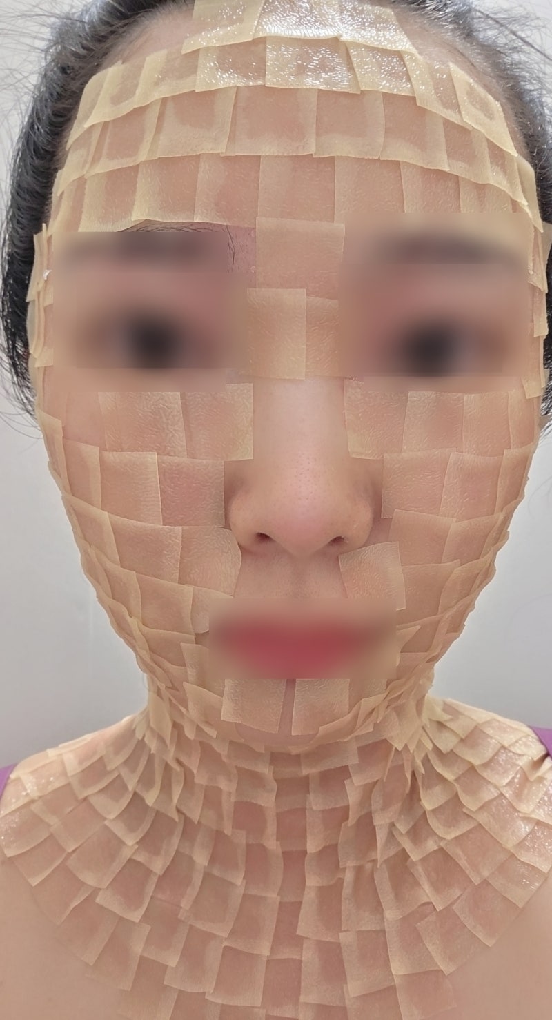 편평사마귀 제거 성지 합정 연세보드미의원 후기