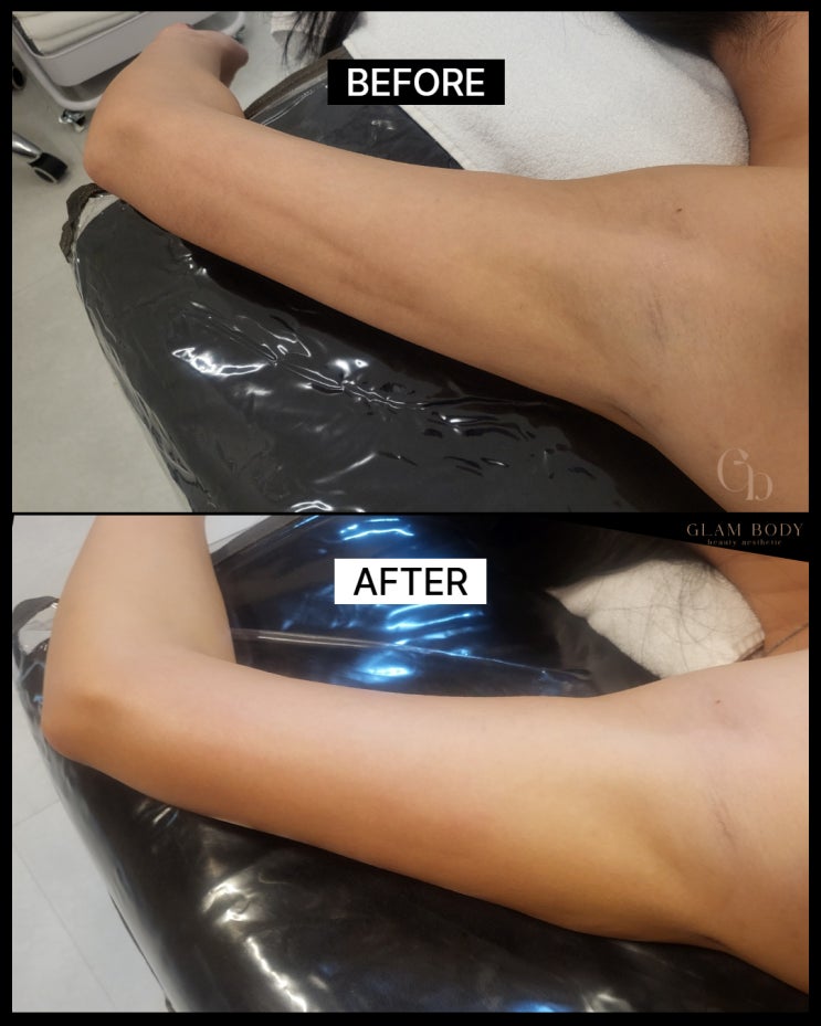  팔뚝 지방흡입 바본, 왜 생길까? 언제부터 관리해야 할까요