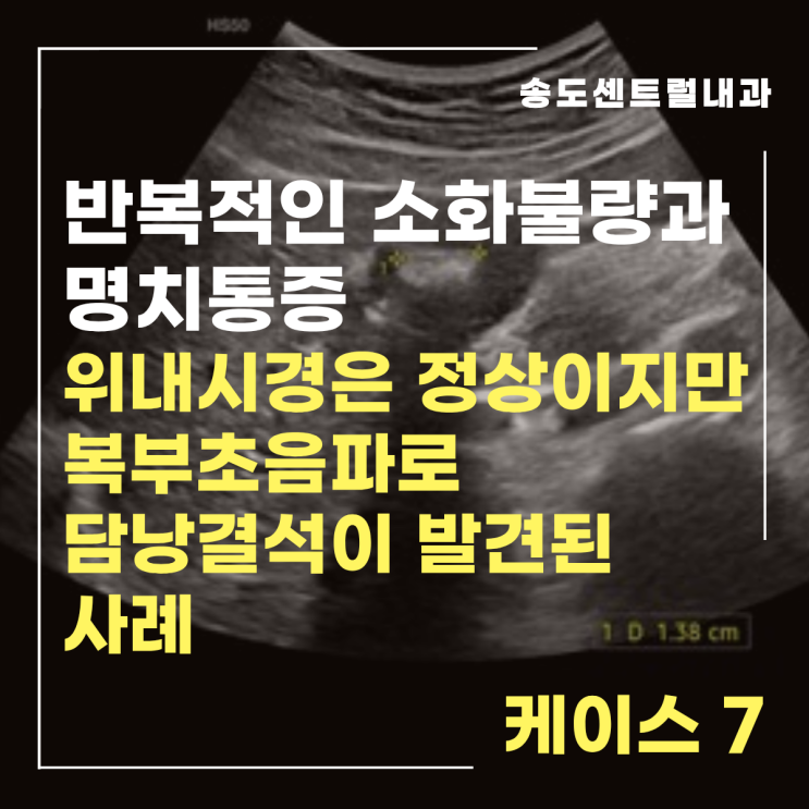  [케이스] 반복적인 소화불량과 명치통증, 위내시경은 정상이었지만 원인은 ‘담낭’