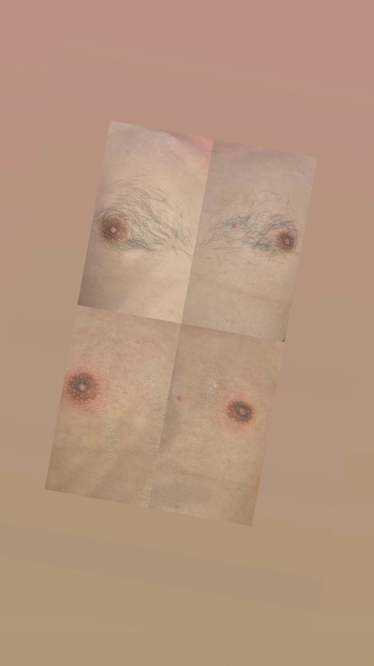  남자 유륜 왁싱으로 자신감을 찾아요, 영등포 왁싱샵 "청춘케어"