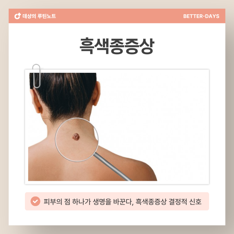 흑색종증상, 피부의 '이 점' 4가지 기준 중 하나라도 해당되면 당장 피부과 가세요