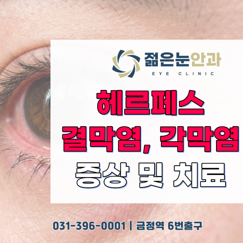 군포 헤르페스 결막염, 각막염이란?(산본, 안양역)