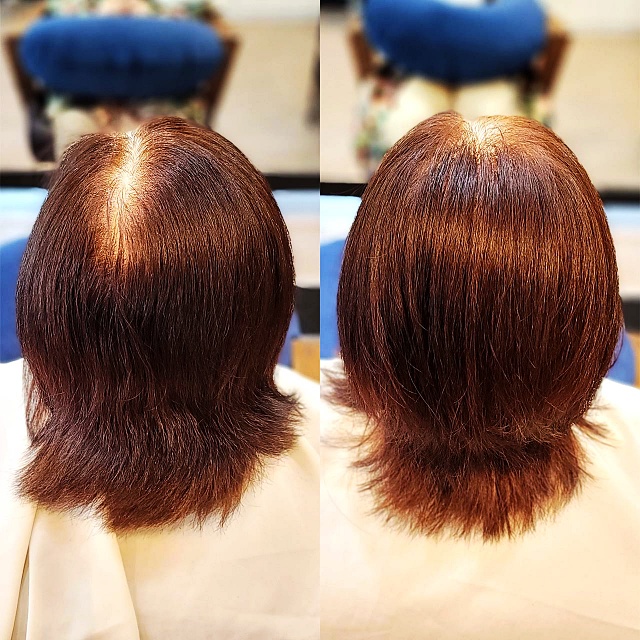  안성 가르마 갈라짐 고민, 넓고 휑한 정수리도 링거펌 모류교정으로 빽빽하게 채워질까요?